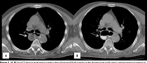 Figure 3 From Mid Esophageal Diverticulum Mimicking An Aortic Aneurysm On Chest Radiography