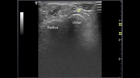 Ulnar Nerve Wrist To Elbow Sonoanatomy Qmh Aed Ultrasound
