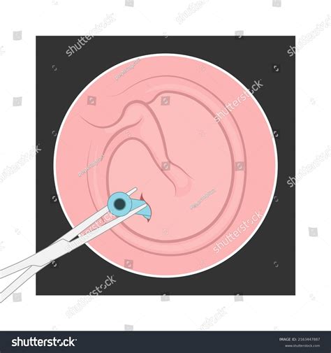Perforated Eardrum Tube Surgical Drain Otitis Stock Vector (Royalty