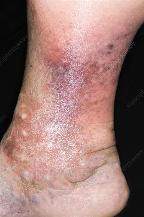 Cellulitis Of The Leg Stock Image C0016610 Science Photo Library
