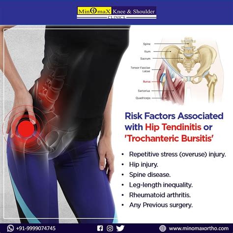Cause Of Trochanteric Bursitis Tb Tb Is Inflammation Swelling Of