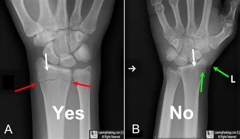 Learning Radiology Fracture Or Not Fracture