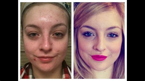 Before After Accutane Before After