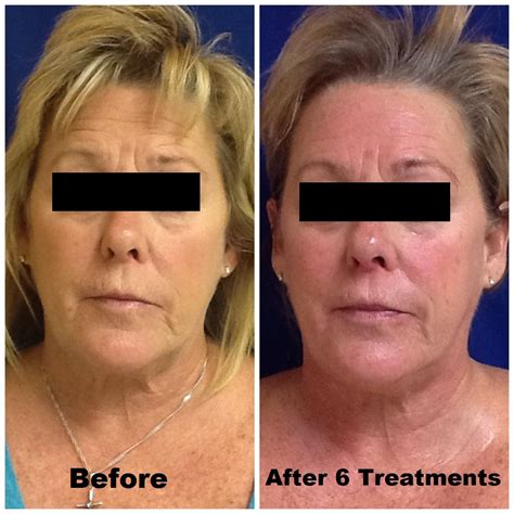Check Out The Amazing Results Our Guest Achieved After Just 6 Venus