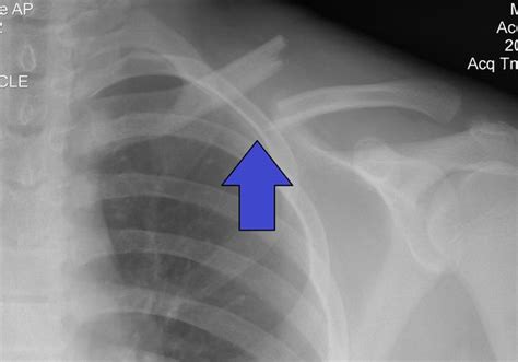 Clavicular Fracture Physiopedia