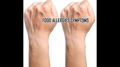 Top 10 Most Common Food Allergies Symptoms To Watch Out For Youtube