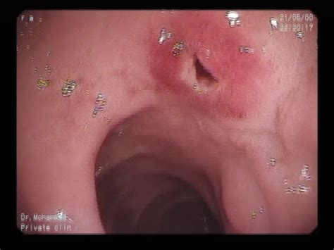 A fistula is an abnormal connection between two body parts, such as an organ or blood vessel and another structure. duodenal fistula - YouTube