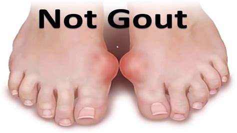 Big Toe Joint Pain Gout