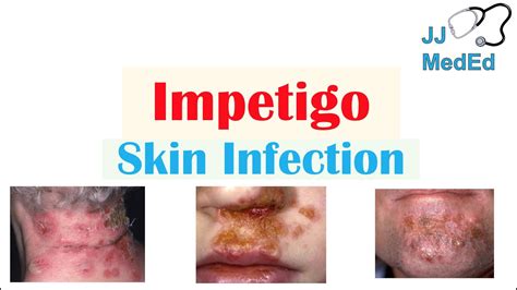 Introduction To Impetigo Infection Subtypes And Treatment