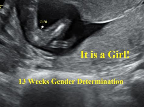 Gender At 13 Weeks