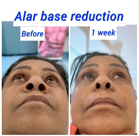 Alar Base Reduction Nostril Reduction Harley Clinic