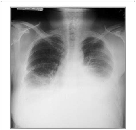 Left Pleural Effusion Chest X Ray Sexiz Pix