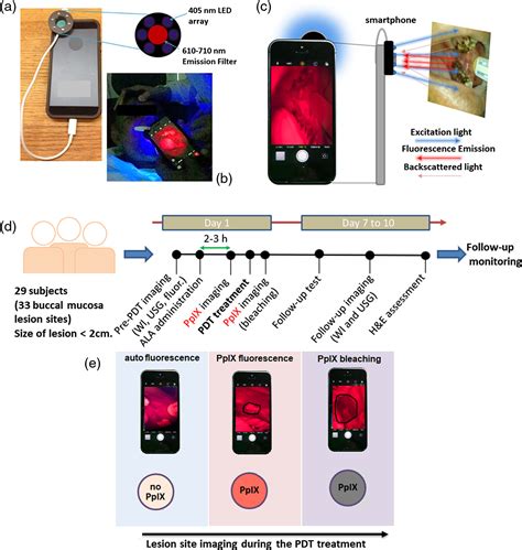 Clinical Evaluation Of Smartphone Based Fluorescence Imaging For
