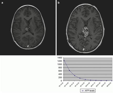 Central Nervous System Germ Cell Tumors Cns Gct Obgyn Key