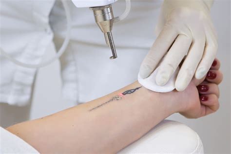 Best Laser Tattoo Removal Machines To Zap That Tattoo In Saved Tattoo
