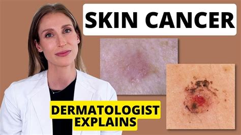Dermatologist Explains Skin Cancer Different Types Causes Prevention