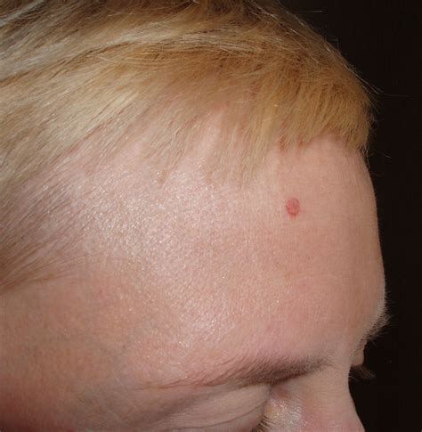 Bumps On Forehead Pictures Photos Vrogue Co
