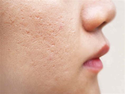 How To Remove Injury Mark On Nose Clearskin Pune