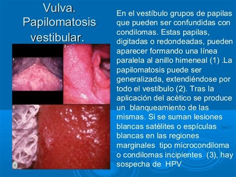 Vulvar Vestibular Papillae