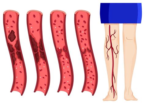 How Are Blood Clots Diagnosed Hamilton Vascular