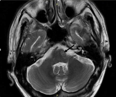Mri Brain Showing Ring Enhancing Lesions Ring Enhancing Lesion In The Download Scientific
