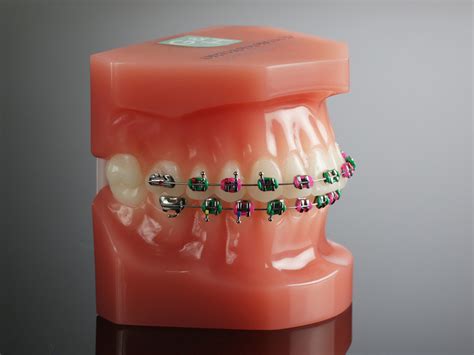 How To Choose The Best Braces Color Zupyak