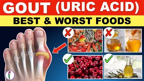 Uric Acid Foods To Avoid Gout Diet Meal Plan Gout Uric Acid Best And Worst Foods Youtube