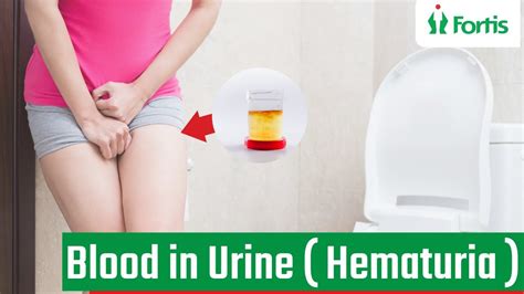 Blood In Urine What Causes Blood In Urine Hematuria Causes Of