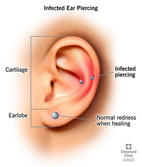 Infected Ear Piercing Symptoms Treatment Prevention Arnoticiastv