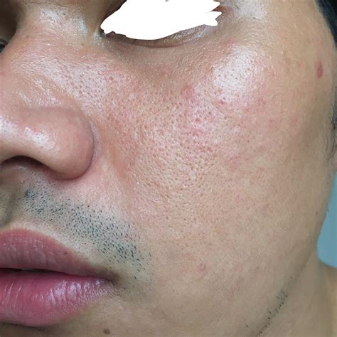 Routine Help Dry Skin With Fungal Acne Badly Need Help For