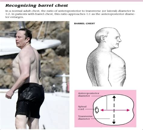 Recognizing Barrel Chest In A Normal Adult Chest The Ratio Of