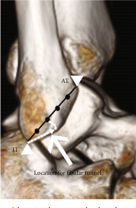 Figure 3 From The Location Of The Fibular Tunnel For Anatomically