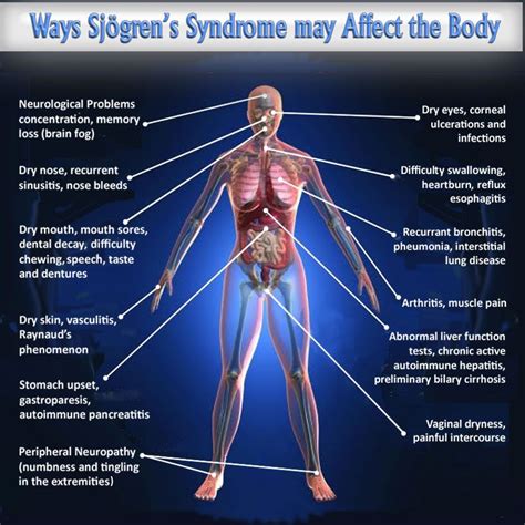 Sjogrens Syndrome Sjogrens Syndrome Sjogrens Disease Symptoms