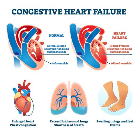 Congenital Heart Disease Causes Symptoms And Treatment