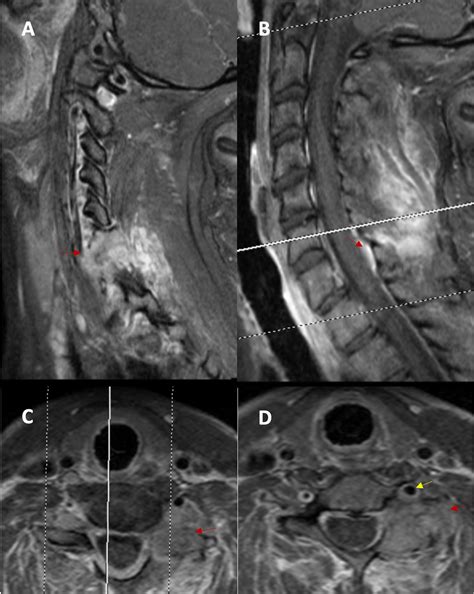 Cureus Tenosynovial Giant Cell Tumor Of The Cervical Spine Case