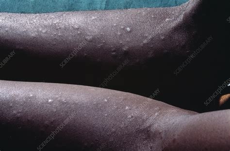 Syphilis Rash In An Aids Patient Stock Image M1120285 Science