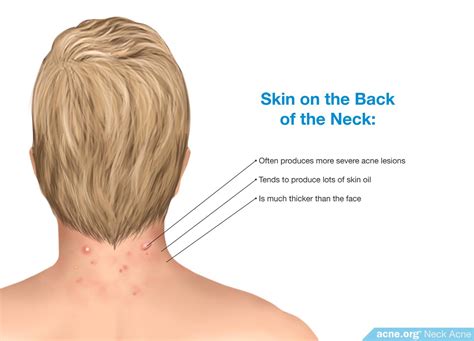 Neck Acne Treatment