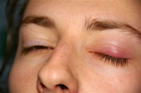 What You Should Know About Eyelid Cysts
