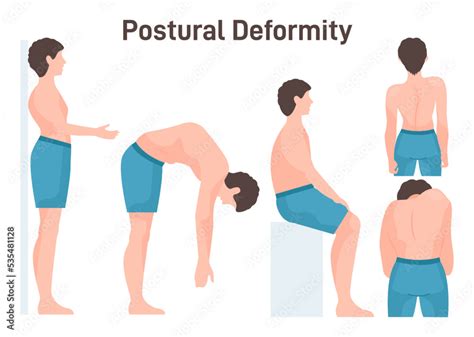 Postural Deformity Scoliosis Curvature Illness Of Spine Body Posture