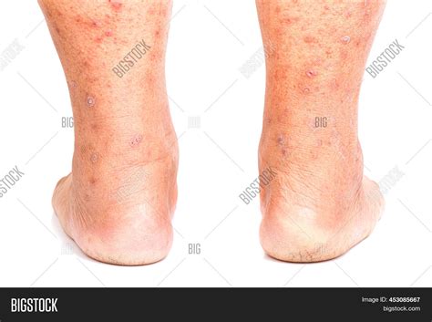 Itchy Skin Lesions Image And Photo Free Trial Bigstock