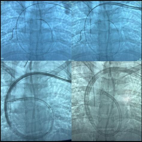 Fluoroscopic Stepwise Images Of Left Subclavian Vein Cannulation With A