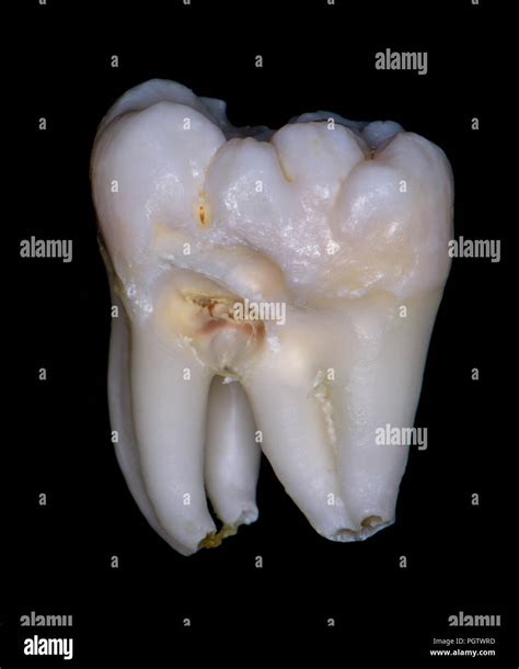 Wisdom Tooth Hi Res Stock Photography And Images Alamy