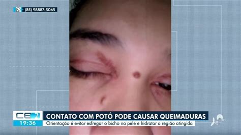 Queimadura De Potó Sintomas