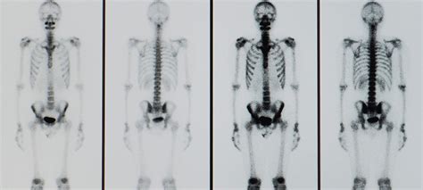 Scintigraphy Allows Doctors To See Changes And Abnormalities Inside