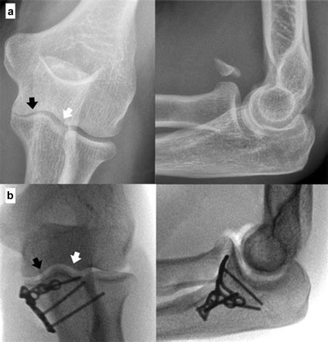 Management Of Anteromedial Coronoid Fractures According To A Protocol