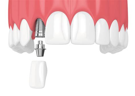 Accuracy Of The Anterior Single Tooth Implant Vital Specialists In