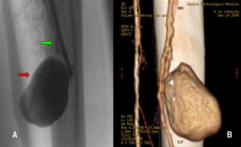 Endovascular Treatment Of A Post Traumatic Tibial Pseudoaneurysm And