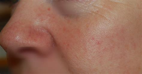 Skin Redness Treatment Near Bristol And Bath Snowberry