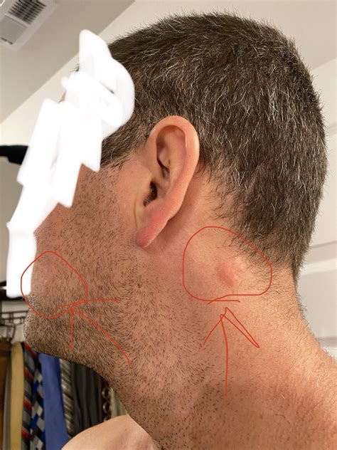 Swollen Lymph Node On One Side Of Neck All In One Photos