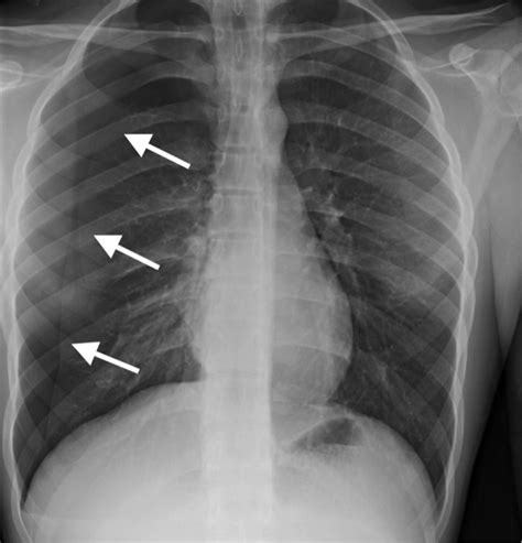 A pneumothorax is an abnormal collection of air in the pleural space between the lung and the chest wall. Spontaneous Pneumothorax - JETem